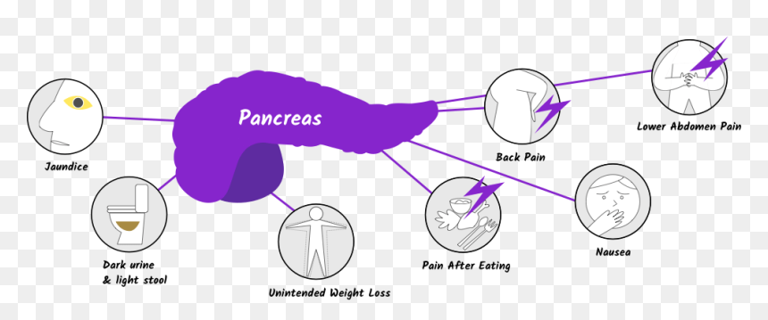 Pancreatic Cancer Symptoms, HD Png Download - pancreas png