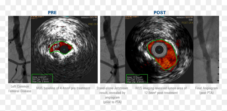 Atherectomy Ultrasound, HD Png Download - jet stream png
