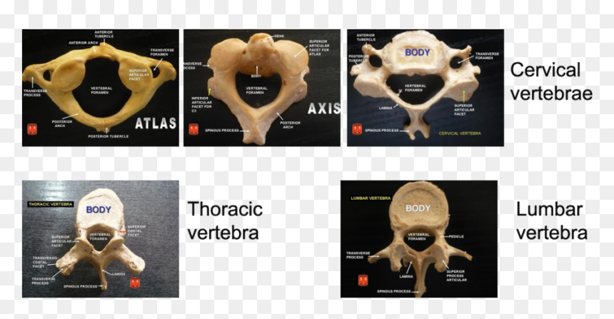 Types Of Vertebrae Anatomy, HD Png Download - bone pile png