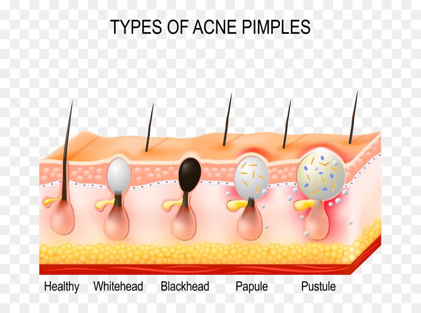 Blackhead Pustule, HD Png Download - pimple png