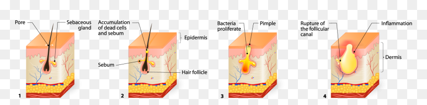 Serous Fluid Pimple, HD Png Download - pimple png