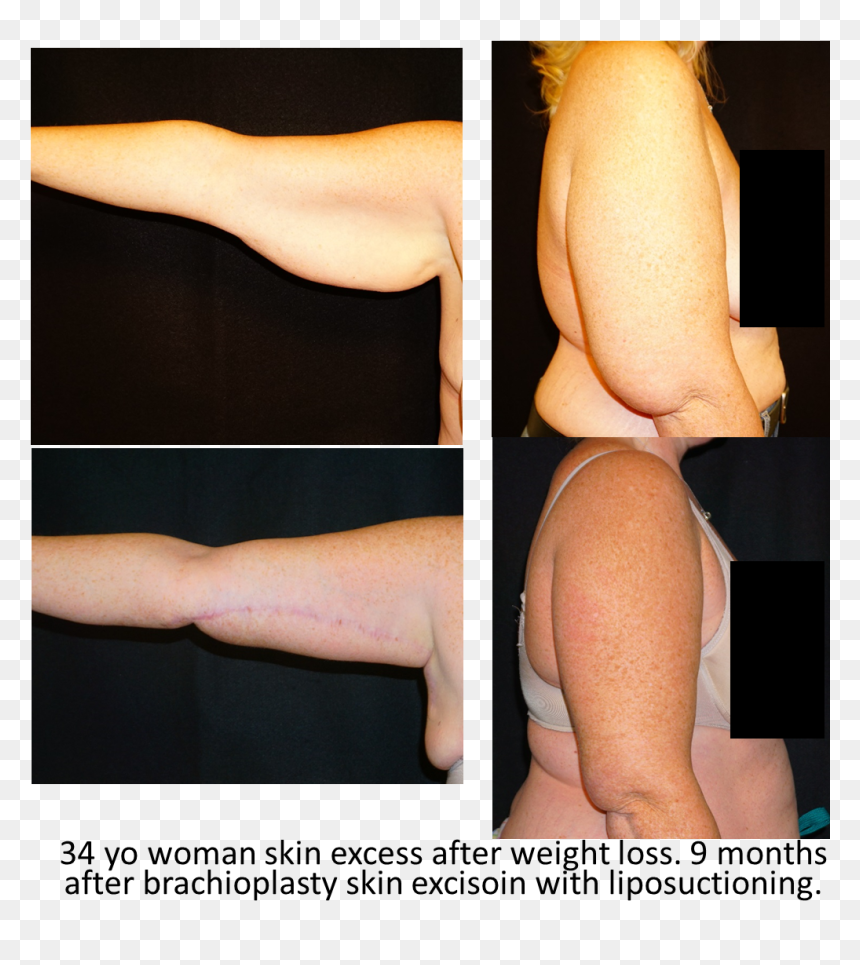 Photo Caption, HD Png Download - muscle arms png