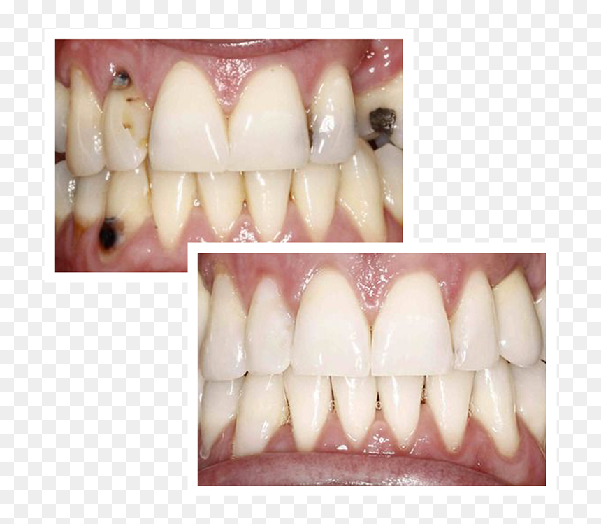 Before And After Full Mouth Reconstruction - Full Mouth Reconstruction, HD Png Download - smiling mouth png
