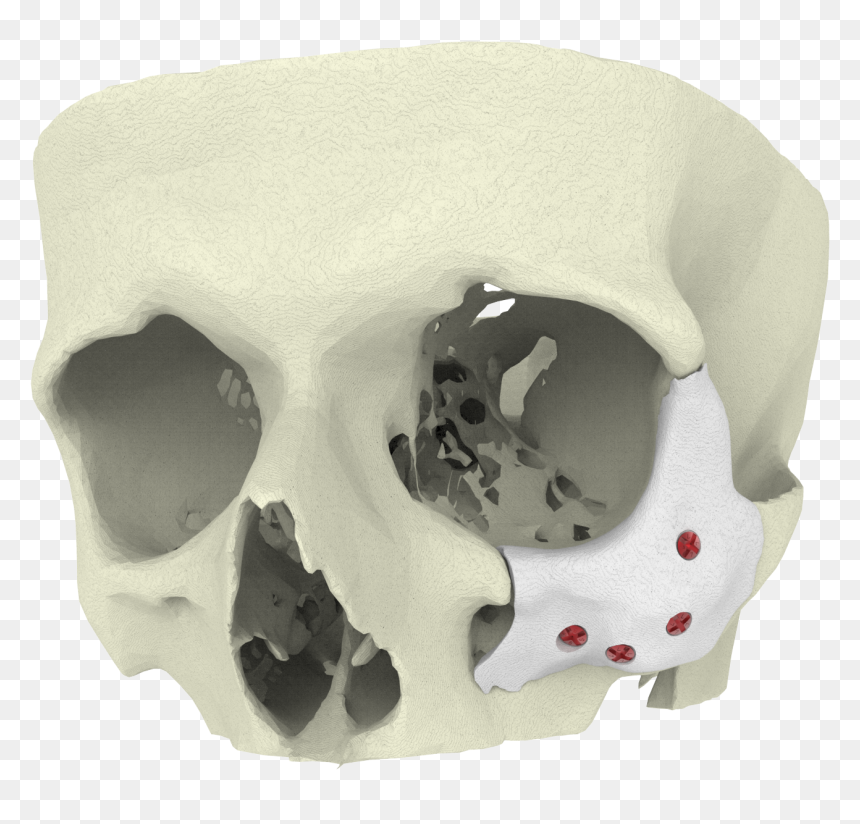 Maxillofacial Surgery Trauma 3d Printing, HD Png Download - bone.png