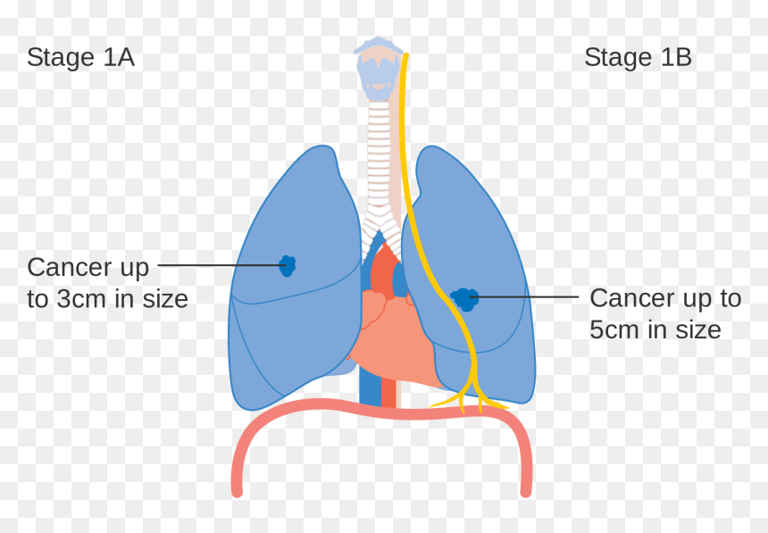 Lung Cancer Stages Diagram, HD Png Download - lung cancer ribbon png