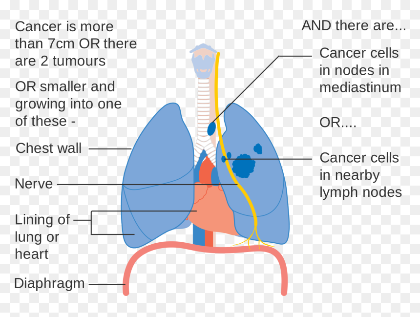 Clip Art Lung Cancer Pictures - Lung Cancer Diagram, HD Png Download - lung cancer ribbon png