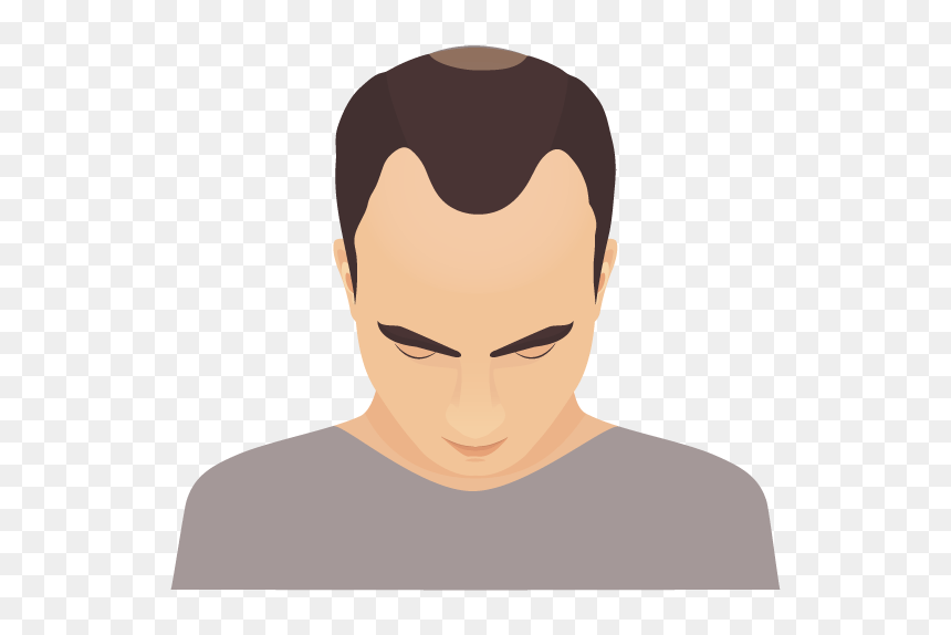 Process Of Going Bald, HD Png Download - man bun png
