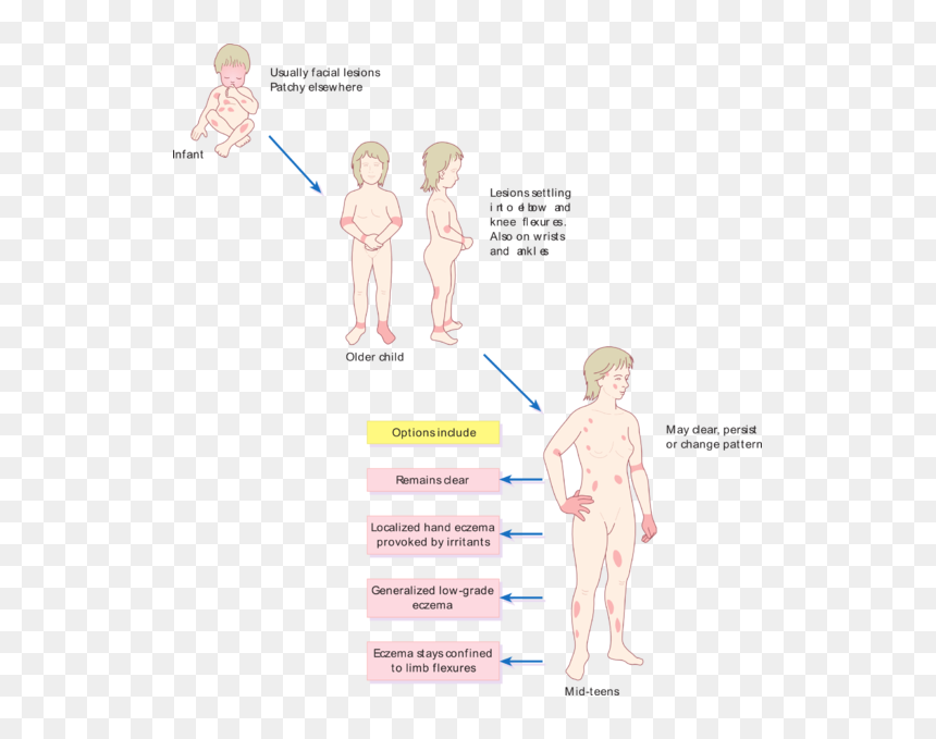Pattern Of Atopic Eczema Varies With Age - Eczema Distribution By Age, HD Png Download - age png