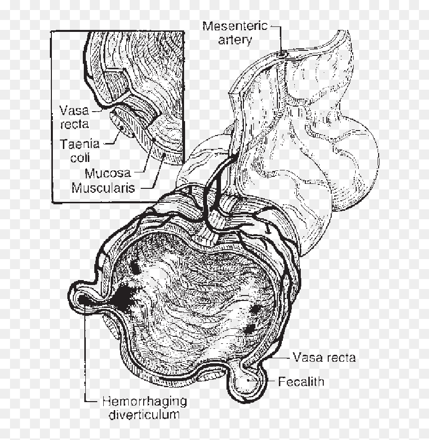 Cross Section Of A Diverticulum, HD Png Download - colon png