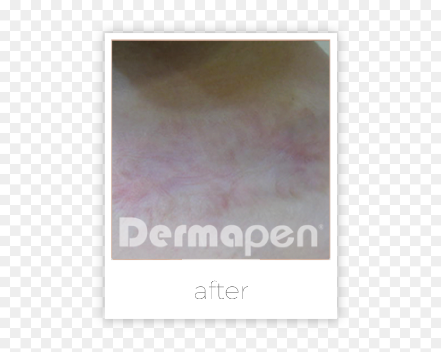 Art, HD Png Download - burn marks png