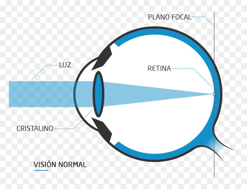 Como Consecuencia, Los Rayos De Luz No Llegan Correctamente - Astigmatismo Png, Transparent Png - rayos de luz png