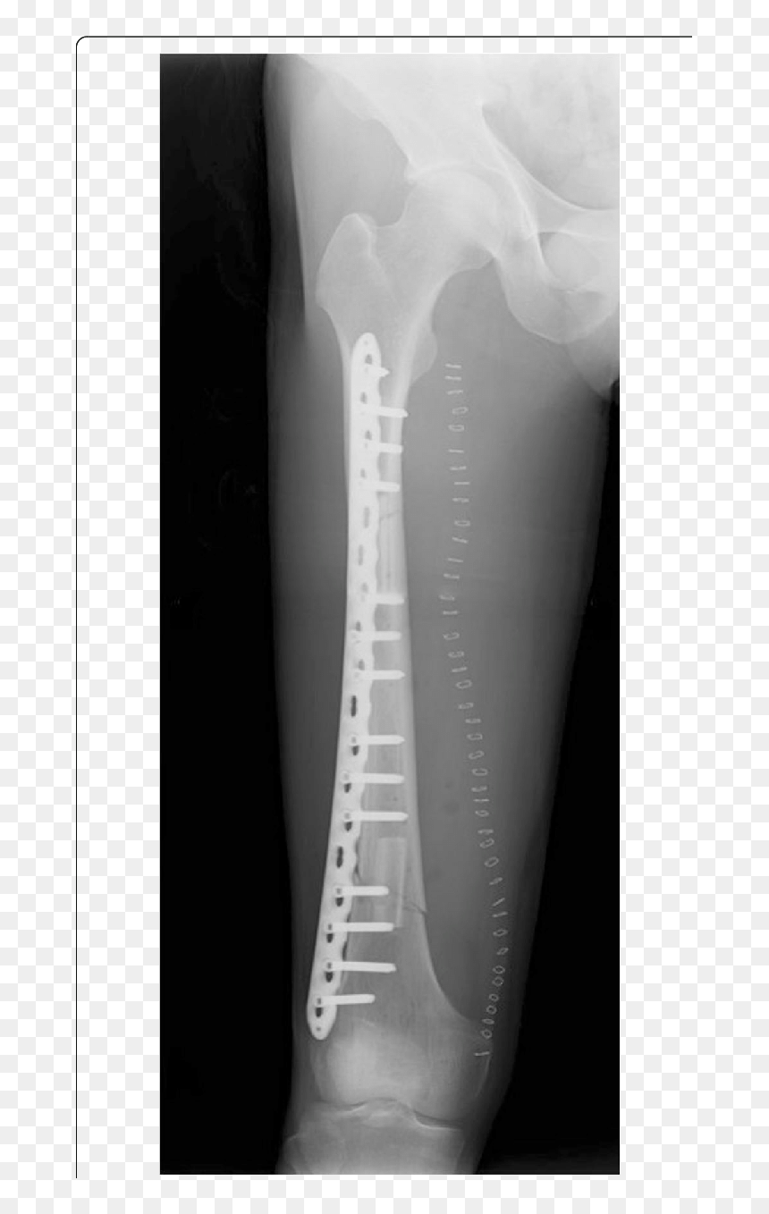 Postoperative Radiography After The Femur Reconstruction - X-ray, HD Png Download - xray png