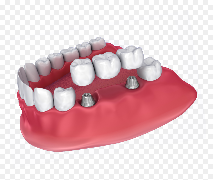 Illustration Of An Implant-supported Bridge - Dental Hd Images Png, Transparent Png - bridges png