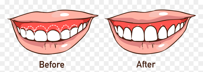 Gum Mouth Clipart - Do Some People Smile With Gums, HD Png Download - mouth clipart png