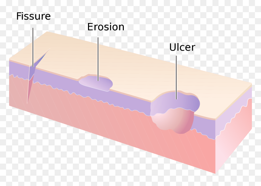Erosion And Ulcer Difference, HD Png Download - cracks texture png