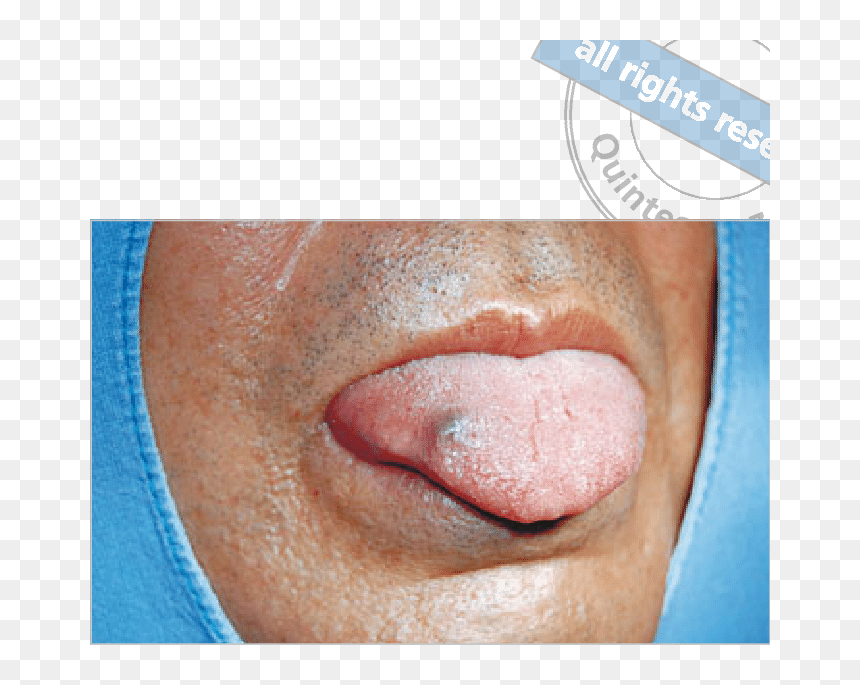 Purple Lump In Tongue, HD Png Download - tongue png