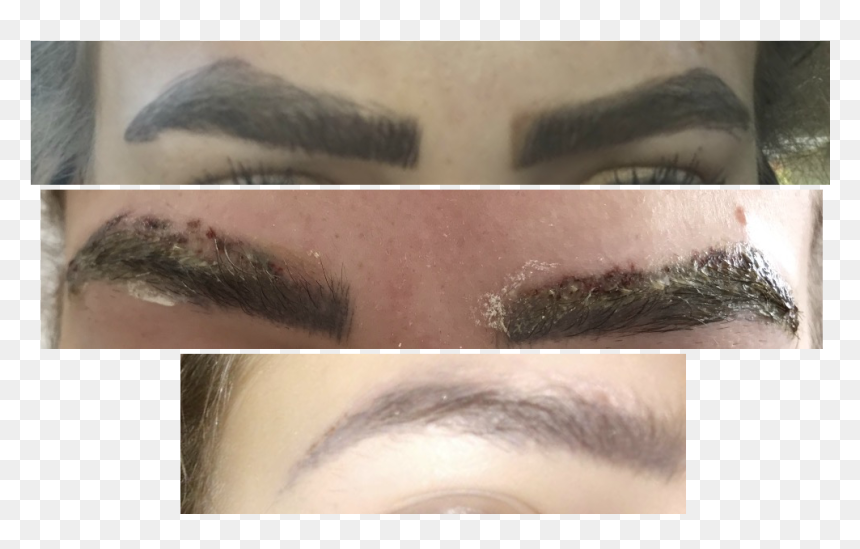 Eyebrow Tattoo Removal Process, HD Png Download - eyebrow png