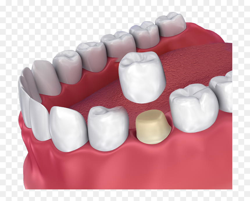 Dental Crown, HD Png Download - teeth grill png