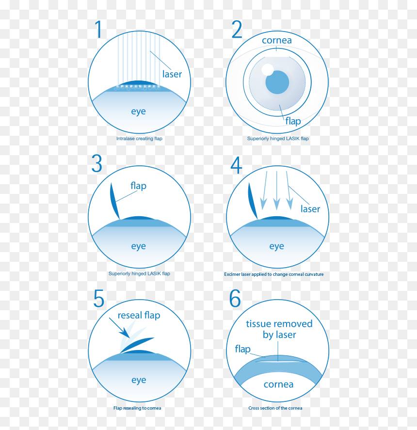 Steps Lasik Eye Surgery, HD Png Download - laser eyes png