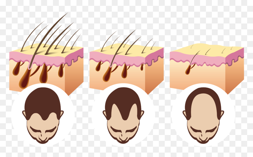 Genetic Male Pattern Balding, HD Png Download - loss.png