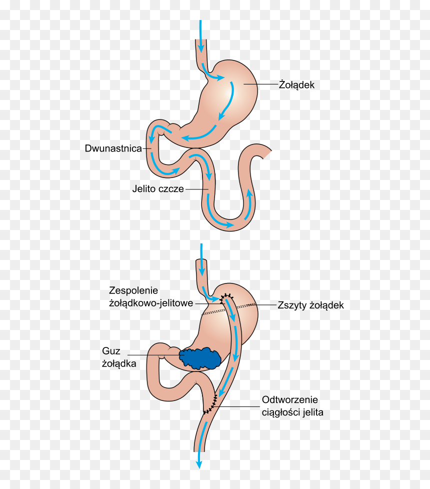 Diagram Showing Before And After Stomach Bypass Surgery - Antrum Żołądka, HD Png Download - before and after png