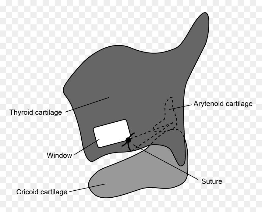 Arytenoid Adduction - Cartoon, HD Png Download - cartoon whale png