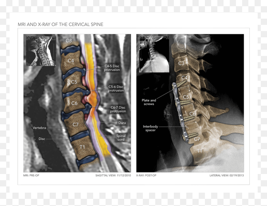 Mri And X-ray Of The Cervical Spine - Medical Imaging, HD Png Download - spine png