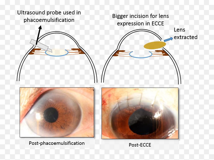 Cataract Surgery - Types Of Cataract Surgery, HD Png Download - eye lens png