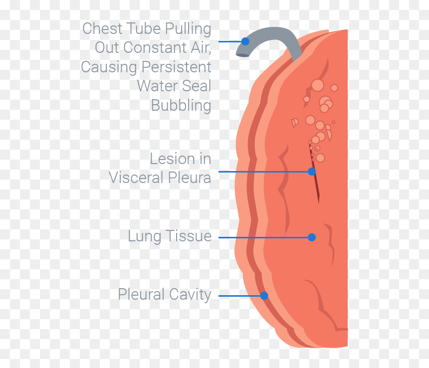 Transparent Air Bubbles Png - Chest Tube Air Bubble, Png Download - leak png