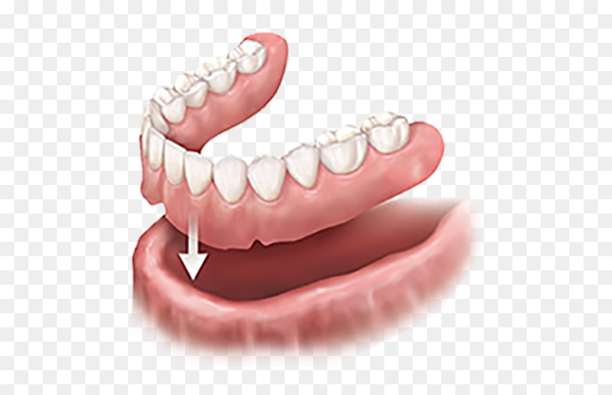 Implant Supported Dentures, HD Png Download - dentures png