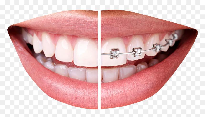 Thumbs Up Png Transparent Image - Teeth Braces Png, Png Download - jaw png