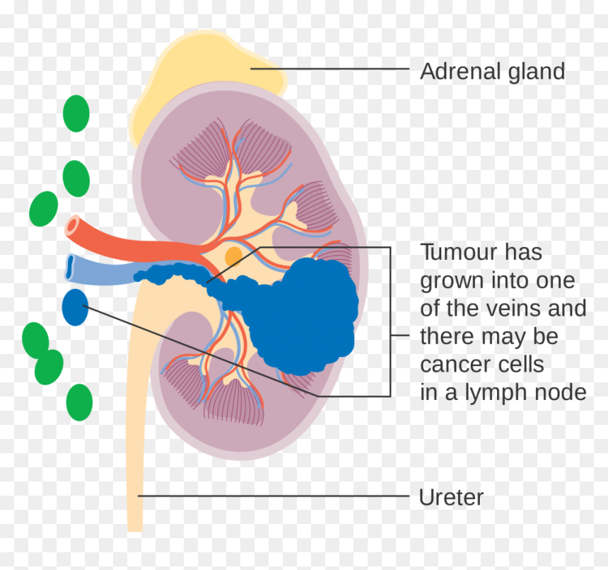 Kidney Cancer Surgery - Kidney Cancer Stage Symptom, HD Png Download - kidneys png