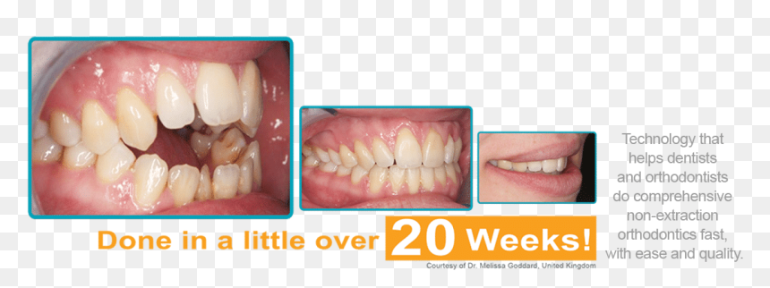 Fast Braces Guam, HD Png Download - scary teeth png