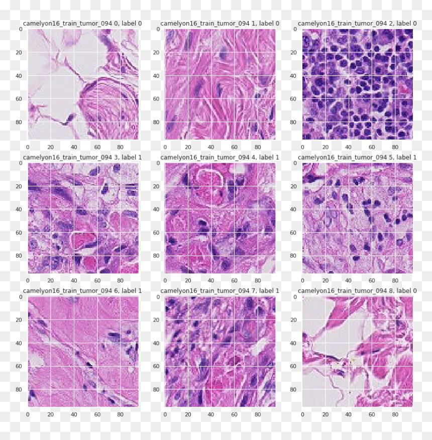 Histopathologic Cancer Detection, HD Png Download - tumor png
