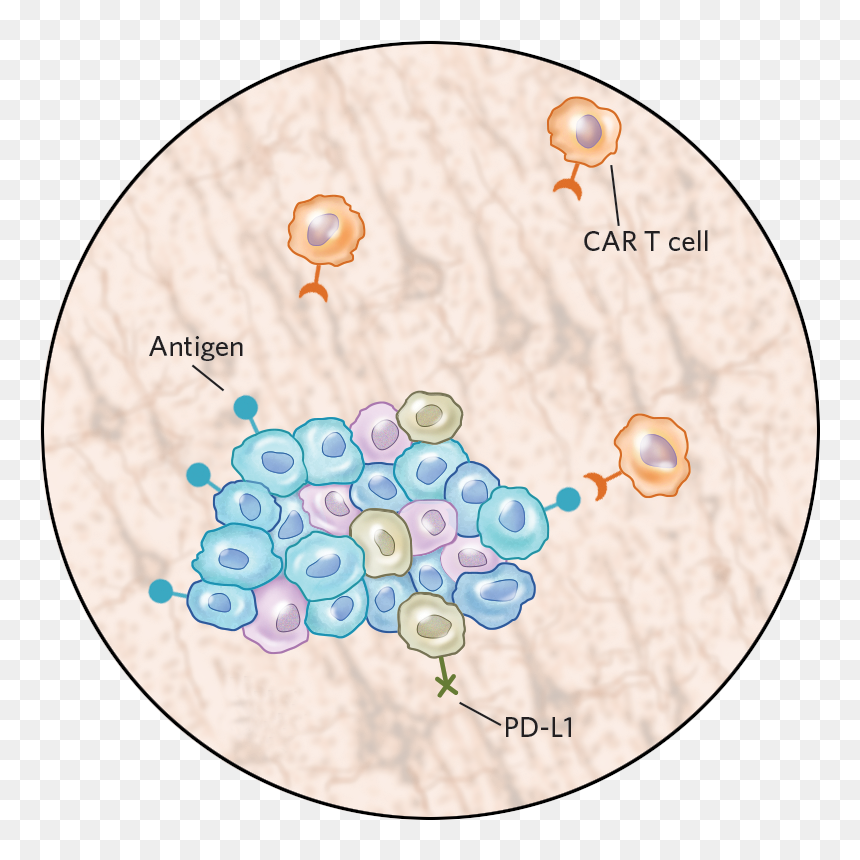 Solid Tumors Vs Liquid Tumors, HD Png Download - tumor png