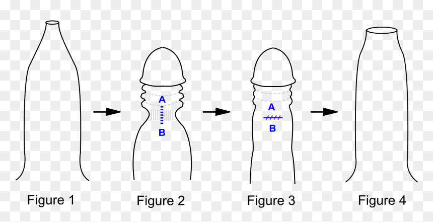 Fimosis Tipos, HD Png Download - dick .png