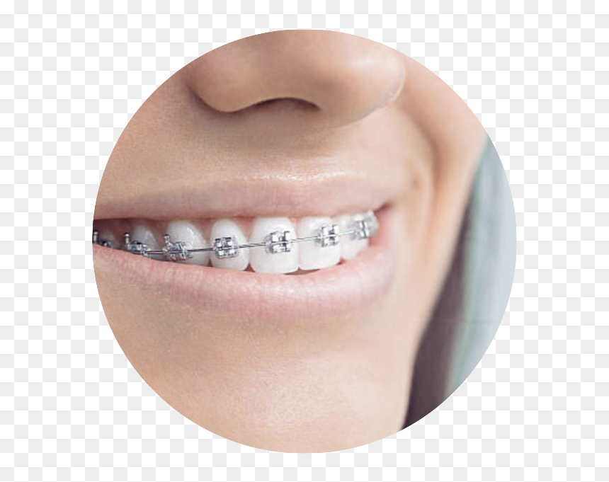 Gold Star Logos & Snippets - White Bands On Metal Braces, HD Png Download - cowboy star png