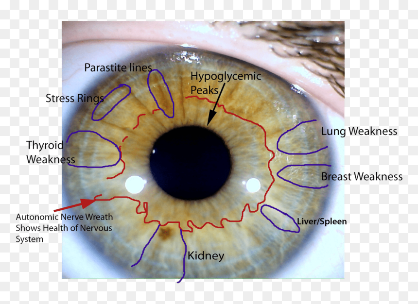 Kidney Stone Iridology, HD Png Download - eye veins png
