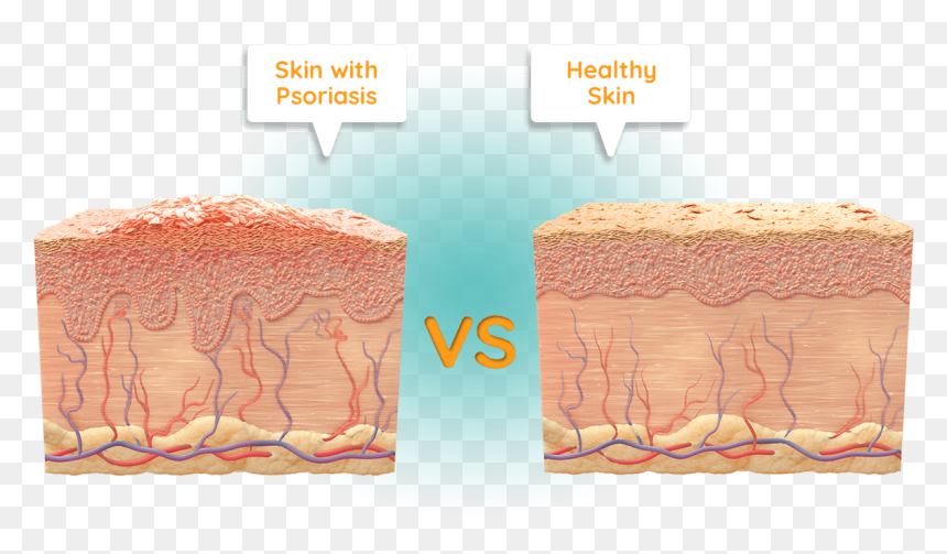 Psoriasis Dead Skin Cell, HD Png Download - sugar pile png