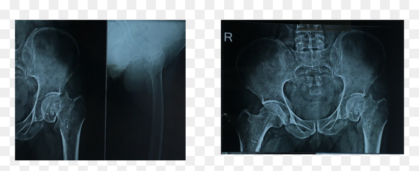 Cover Image - Radiology, HD Png Download - femur png