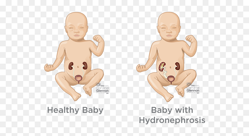 Blocked Bladder, HD Png Download - baby in womb png