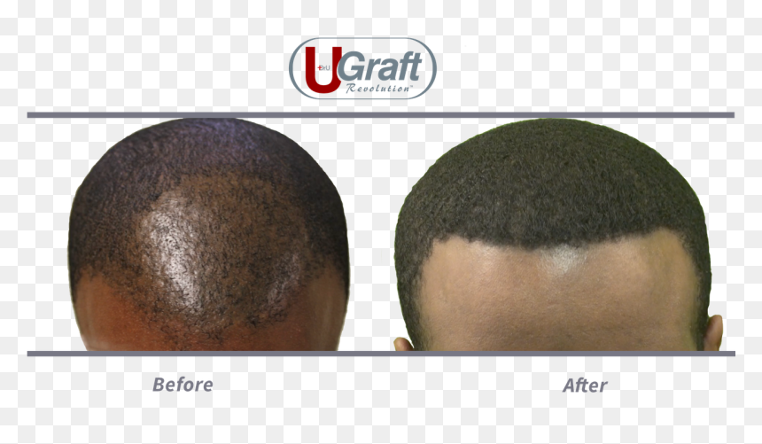 This Patient Benefited From 1400 Grafts Safely Extracted - Buzz Cut, HD Png Download - hair texture png
