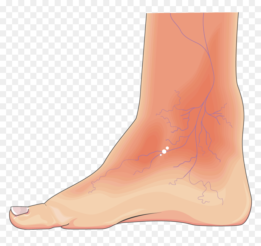 Diabetic Foot Png, Transparent Png - foot png