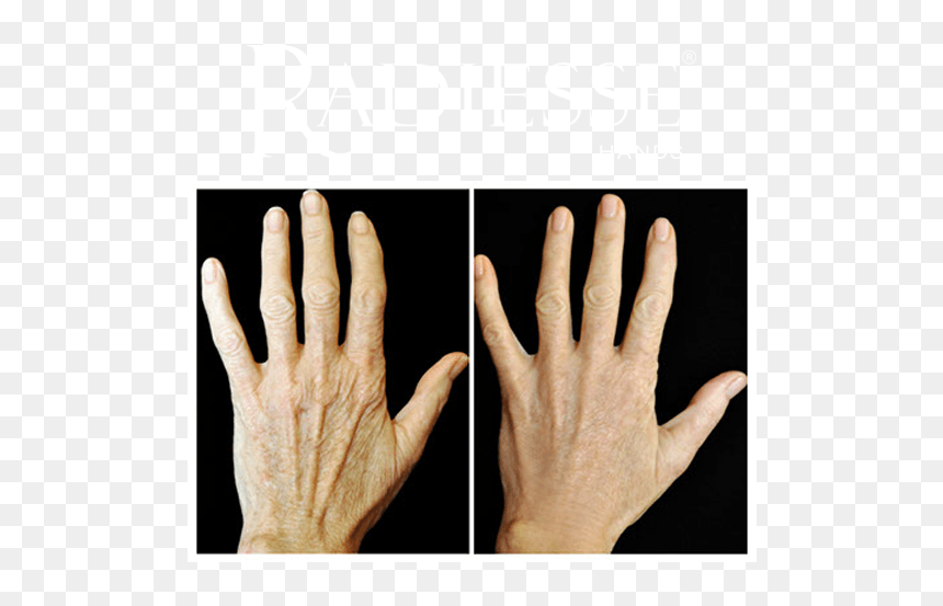 Before And After Treatment With Radiesse® Hands - Radiesse Hands, HD Png Download - clock hands png