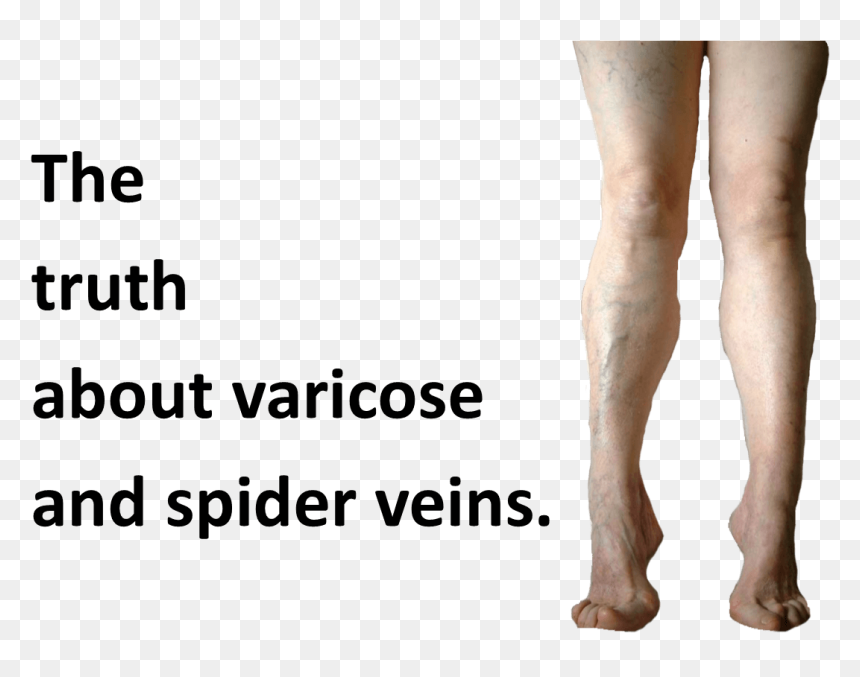 Spider Veins Photos - Tights, HD Png Download - veins png