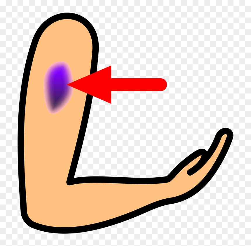 Transparent Blindfold Clipart - Bruise Clipart, HD Png Download - bruise png
