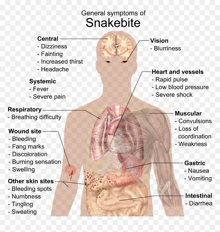 Infectious Mononucleosis, HD Png Download - bite mark png