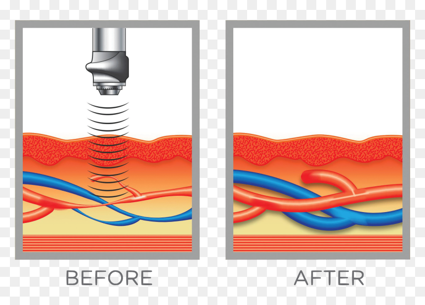 Swiss Wave Therapy Demo11 - Blood Flow Penis, HD Png Download - shockwave png