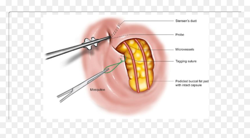 Blunt Transparent Fat - Herniation Of Buccal Fat Pad, HD Png Download - weed blunt png