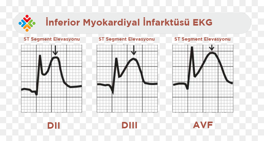 St Elevation Mi, HD Png Download - ekg png